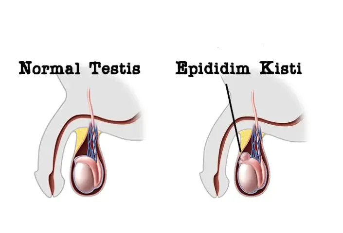Epididim Kisti Eksizyonu