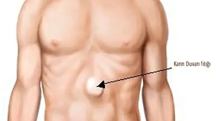 Epigastrik Herni Onarımı