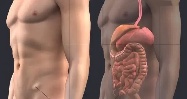 Femoral Herni Onarımı