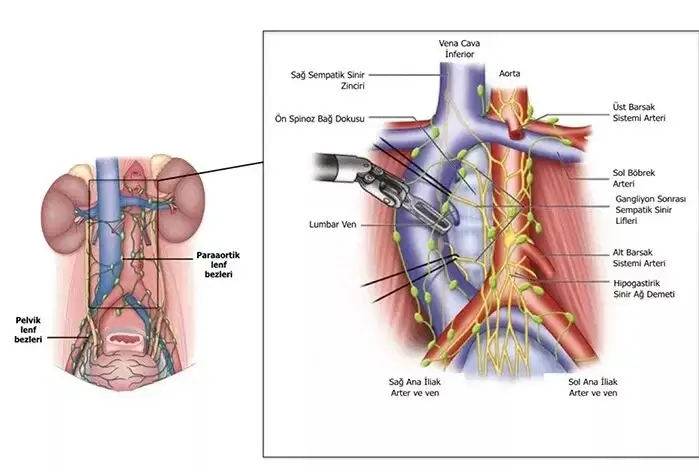 İliyoinguinal Lenf Nodu Diseksiyonu