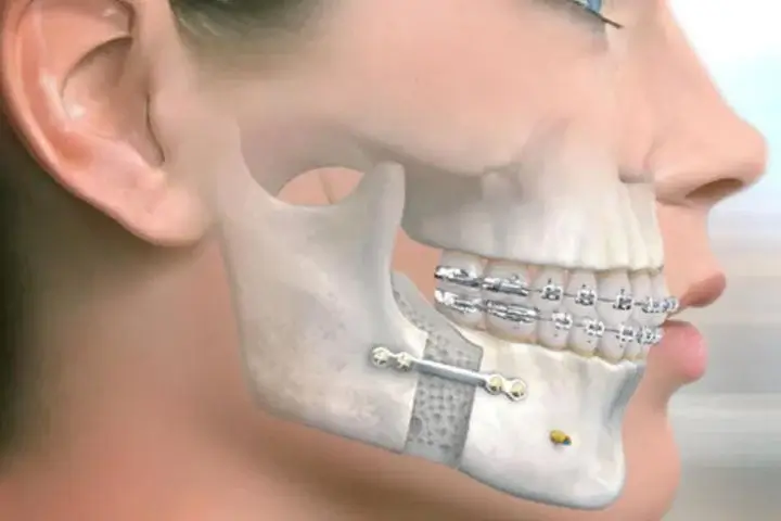 Maksilla Veya Mandibula Kırığı Cerrahisi