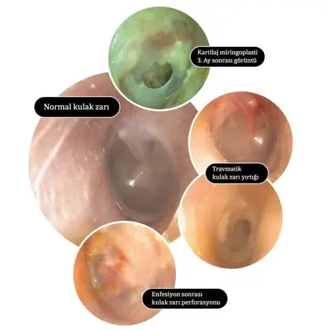 Miringoplasti