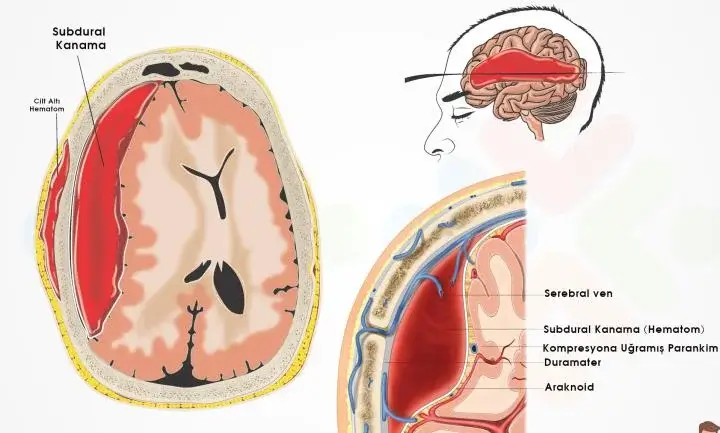 Subdural Hematom Drenajı