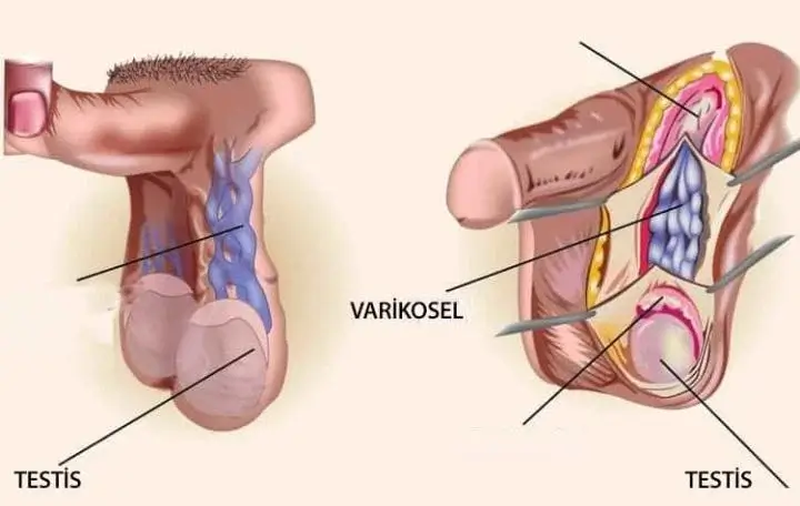 Varikoselektomi