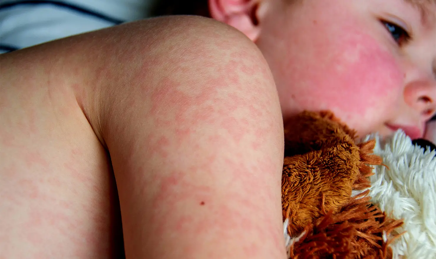 Altıncı Hastalık (Roseola Infantum)