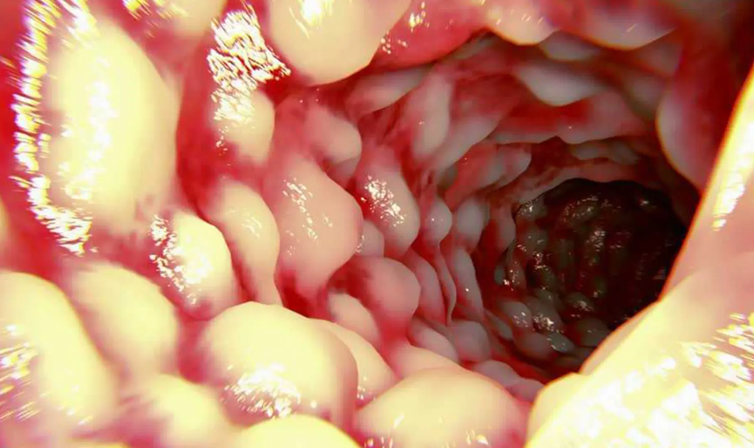 Crohn Hastalığı