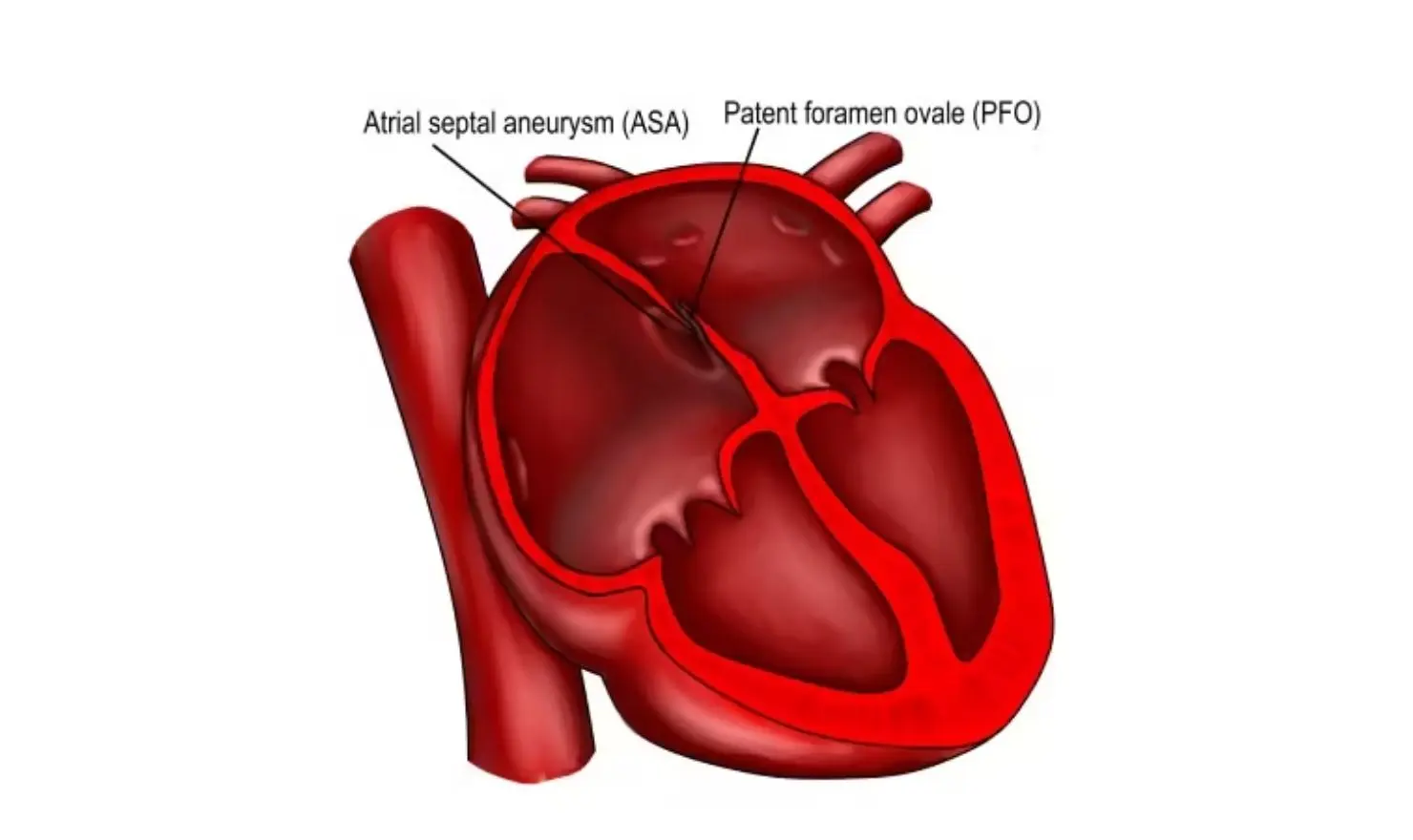 Patent Foramen Ovale (PFO)
