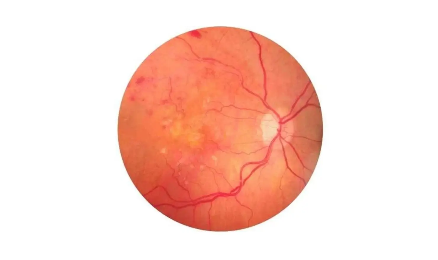 Prematüre Retinopatisi