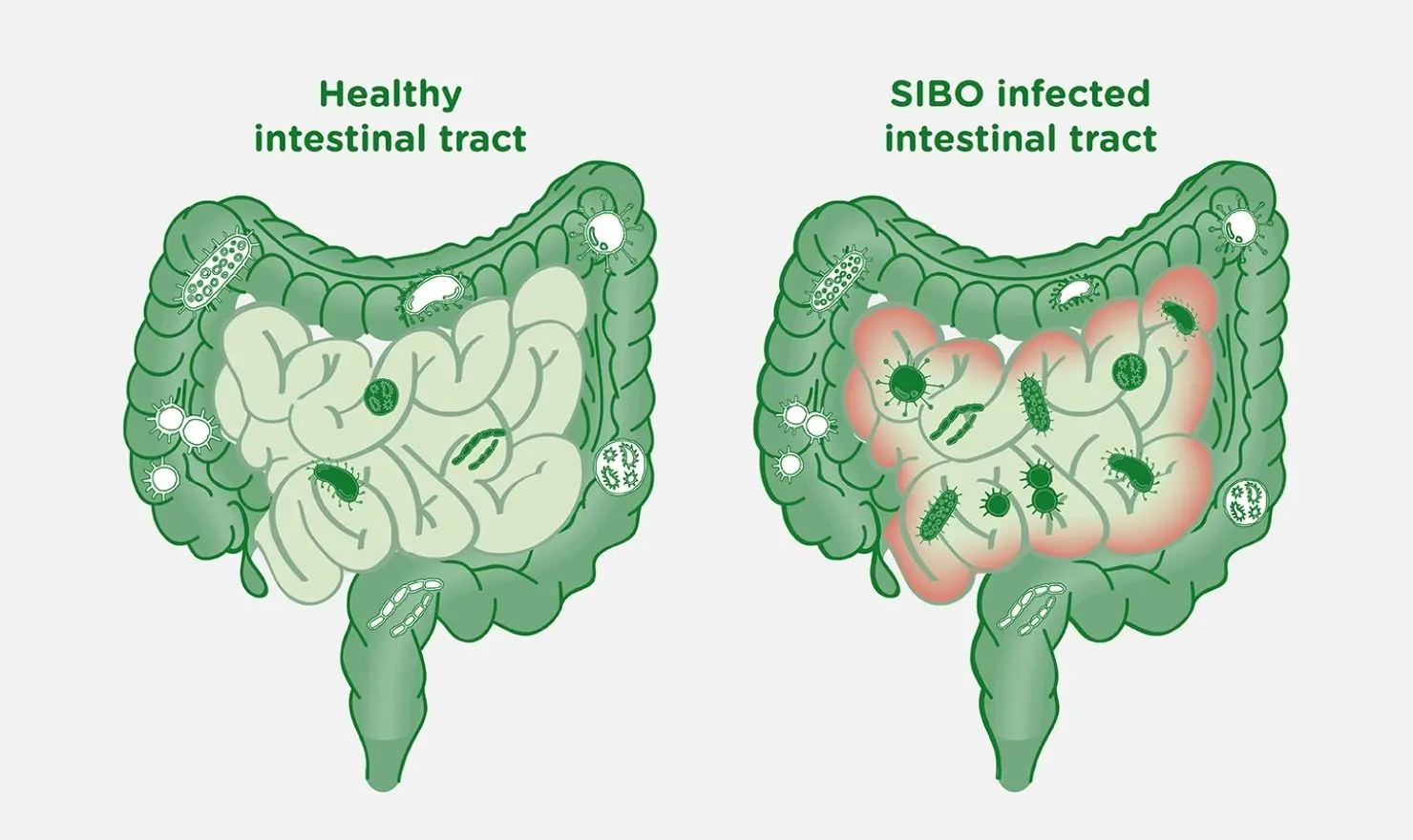 SIBO (İnce Bağırsaklarda Aşırı Bakteri Çoğalması)