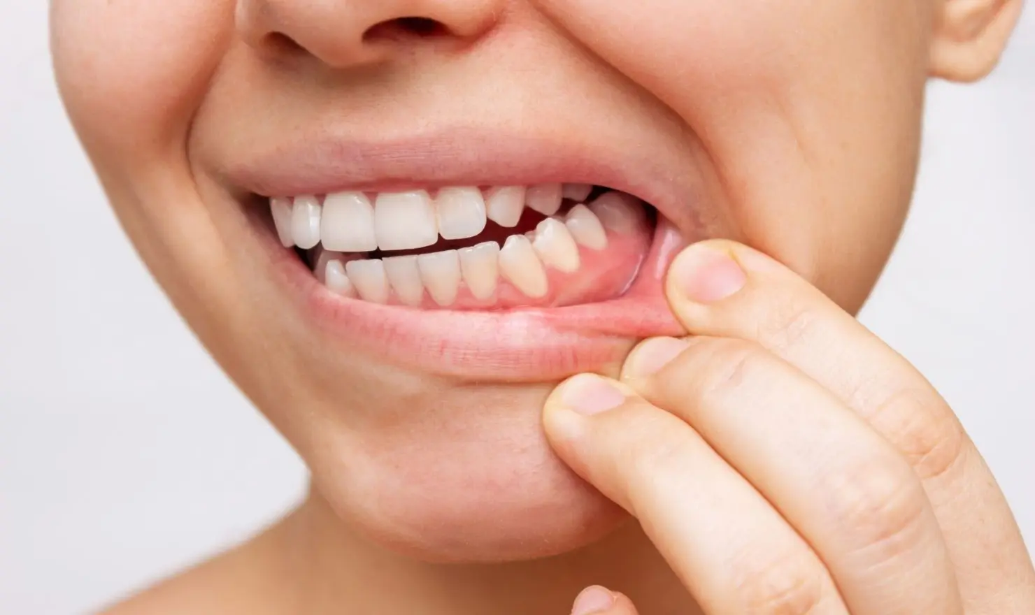 Skorbüt Hastalığı