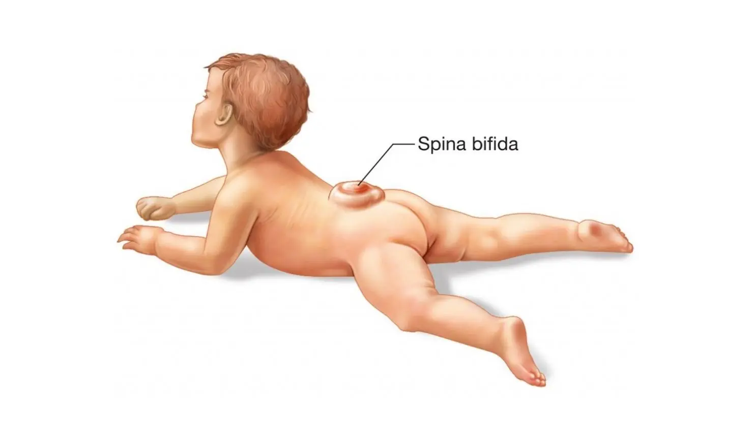 Spina Bifida