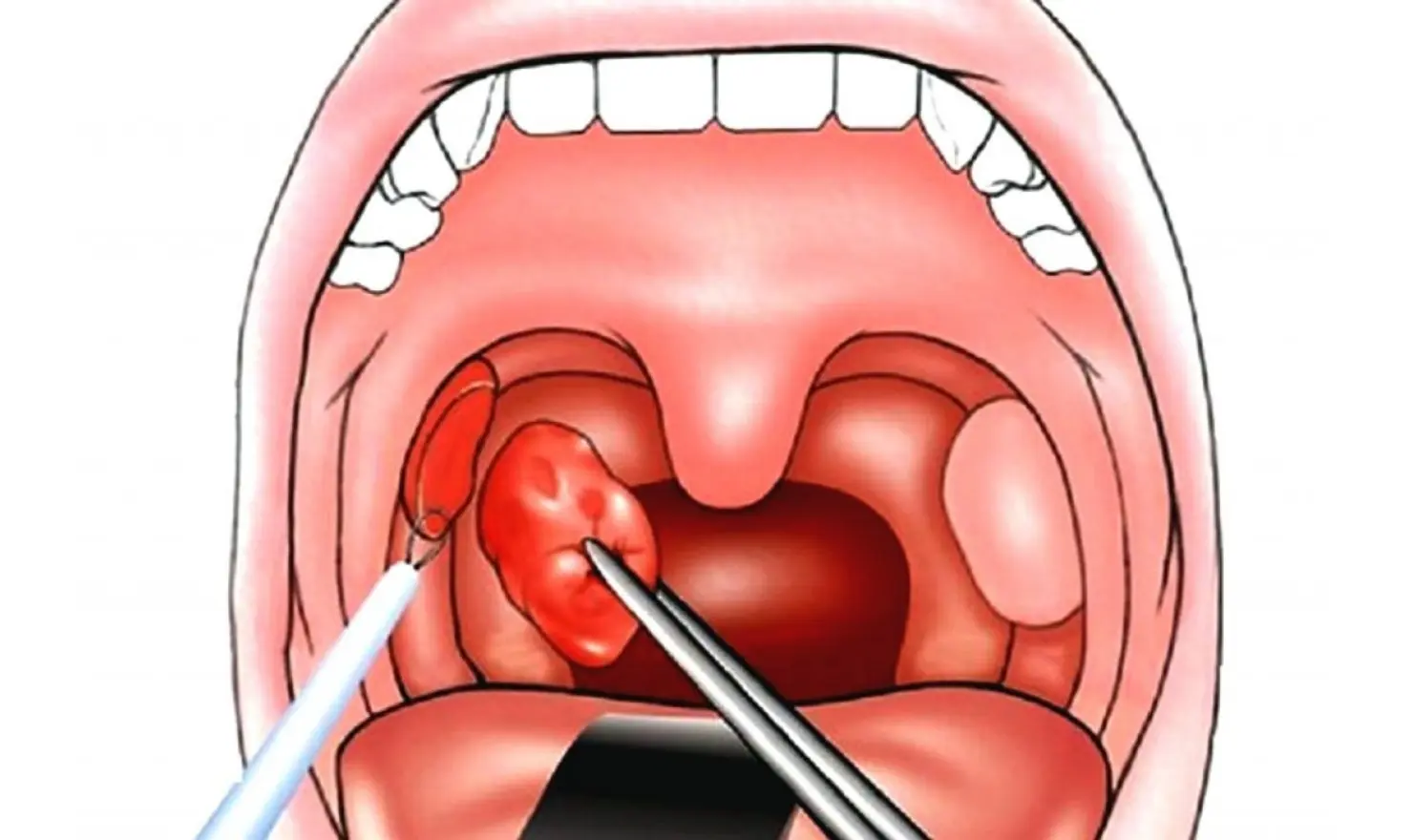 Tonsilit (Bademcik İltihabı)