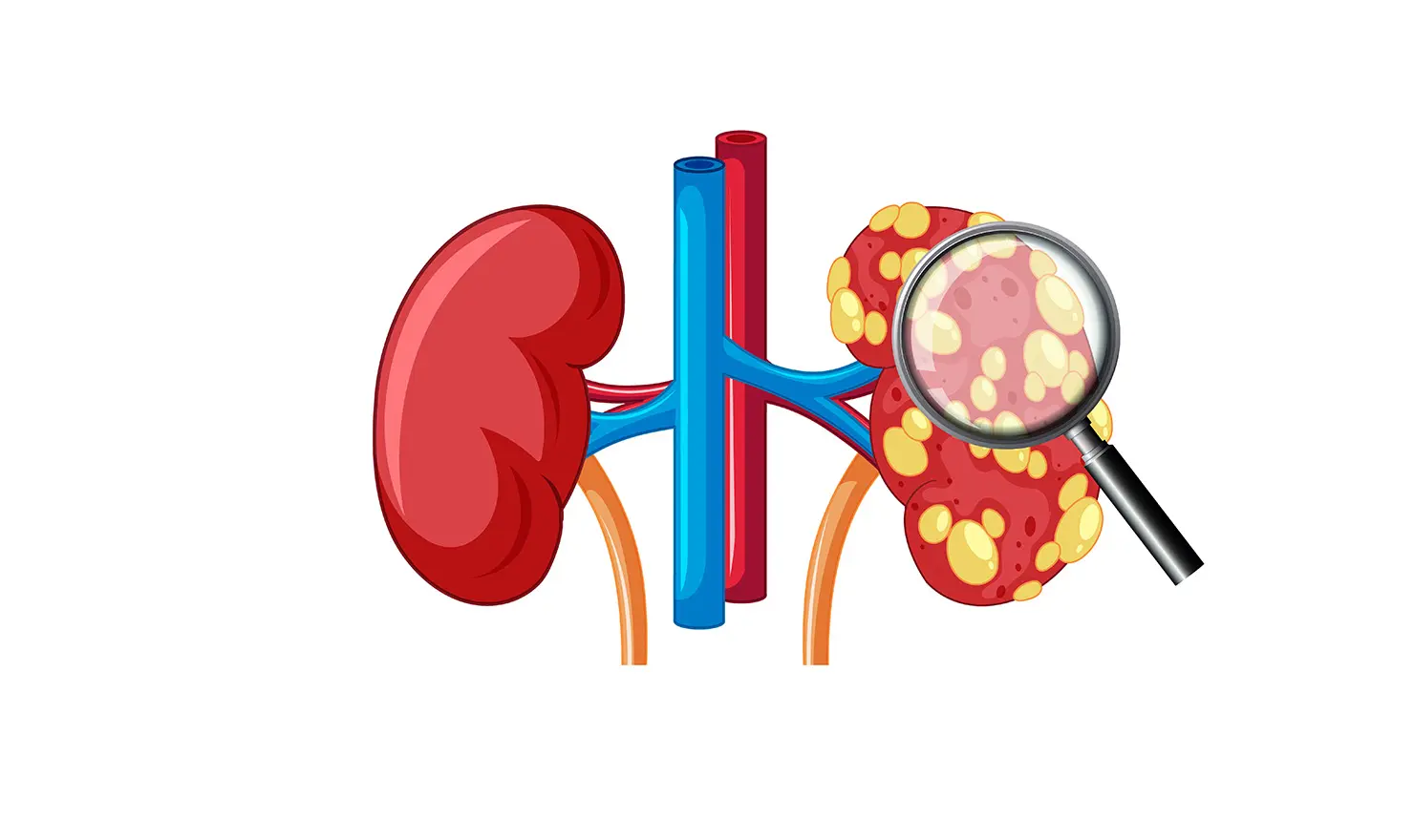 Wilms Tümörü (Nefroblastom)