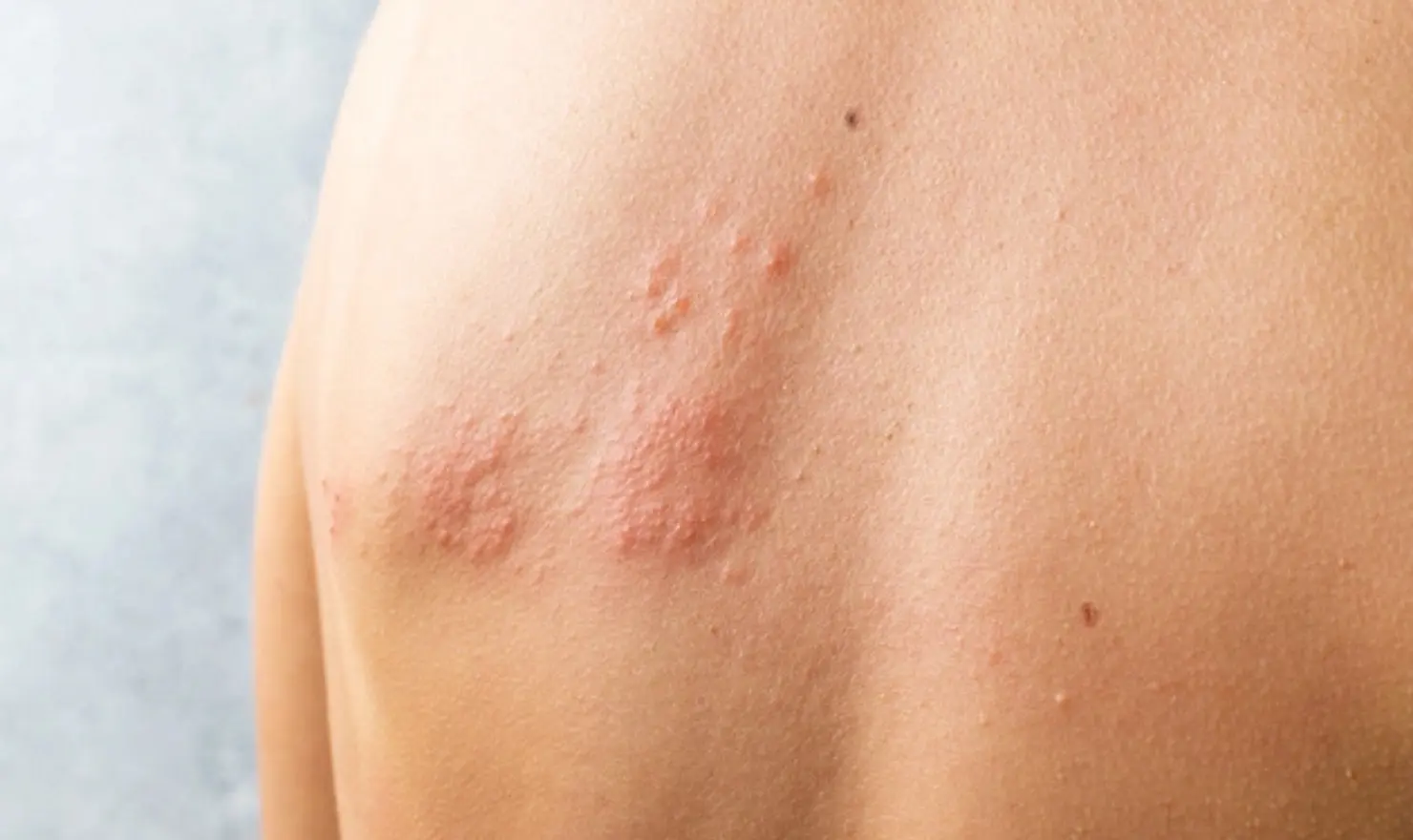 Zona (Gece Yanığı)